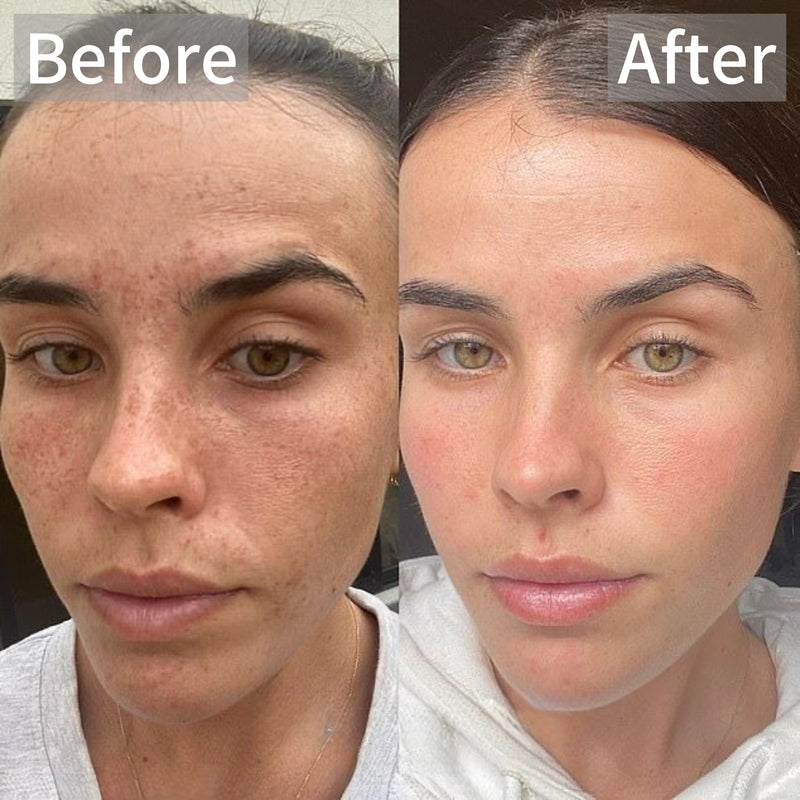 BRIGHTEN°001 - KOJIC ACID SERUM