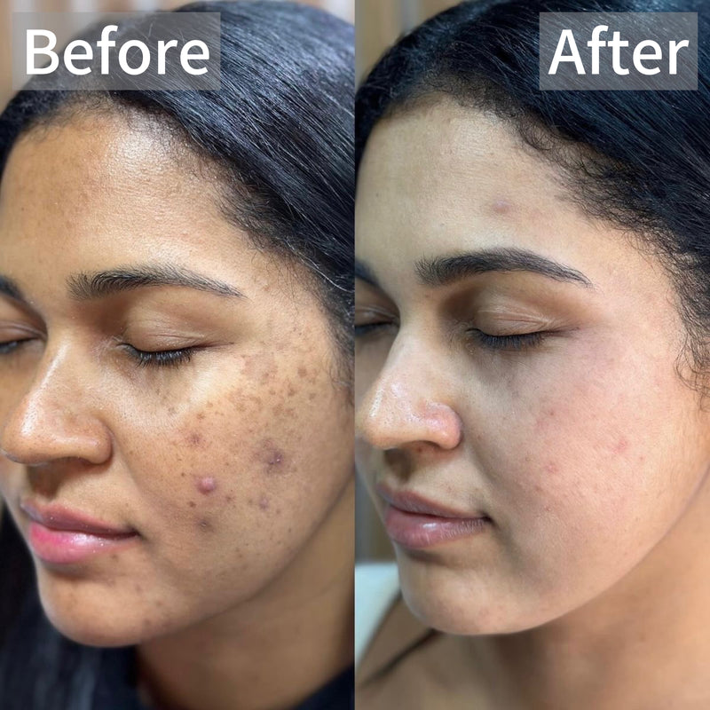 BRIGHTEN°001 - KOJIC ACID SERUM