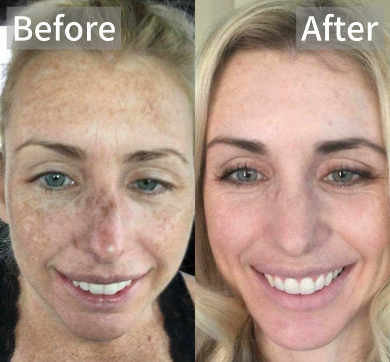 BRIGHTEN°001 - KOJIC ACID SERUM