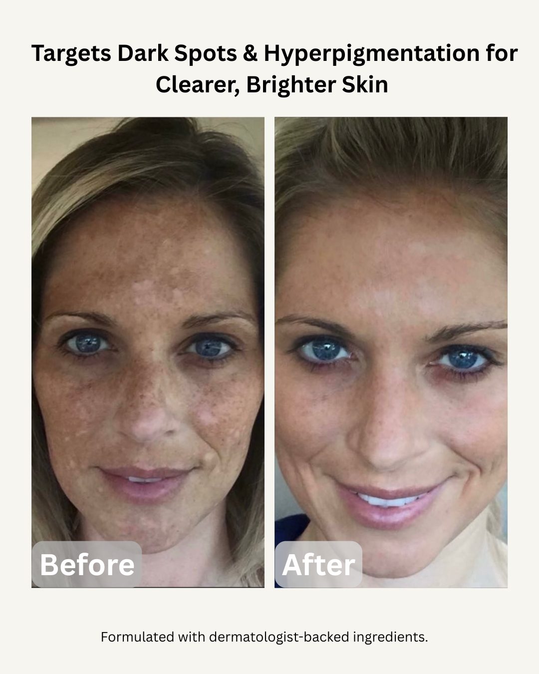 BRIGHTEN°001 - KOJIC ACID SERUM